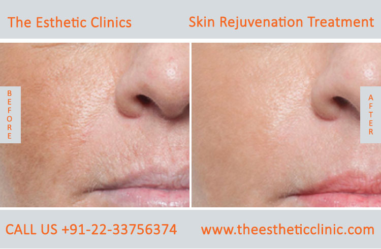 Skin Rejuvenation whitening lightening Laser Treatment before after photos in mumbai india (1)